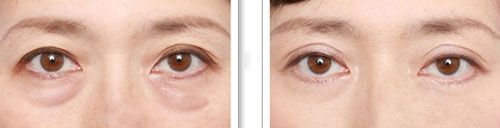 下眼袋的细纹比较多怎么救,眼袋每天怎样按摩