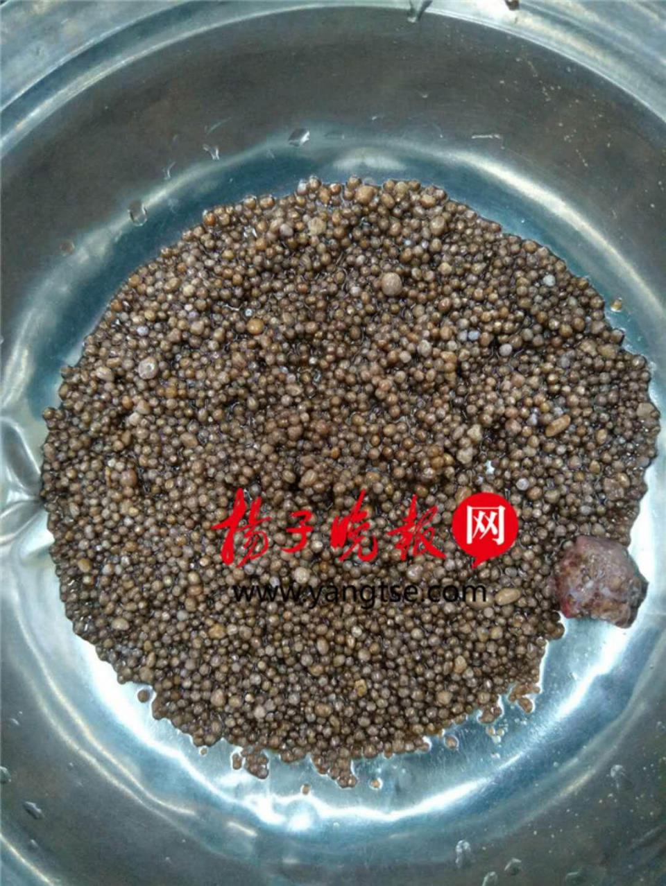 网传江苏一大妈肾脏长了2980颗结石?对肾结石你真的了解吗?