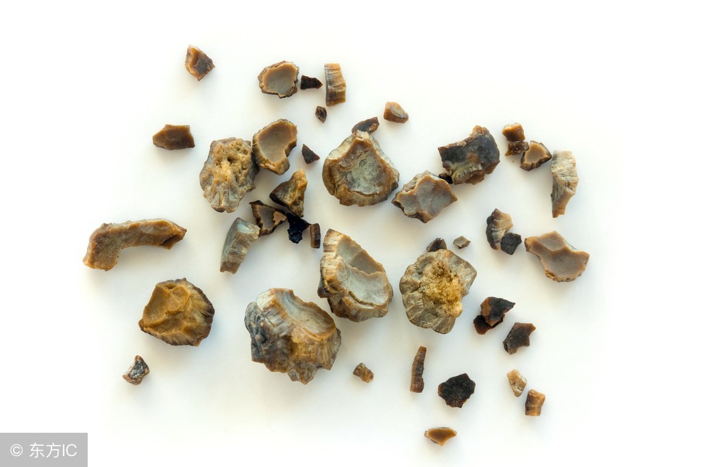 网传江苏一大妈肾脏长了2980颗结石?对肾结石你真的了解吗?