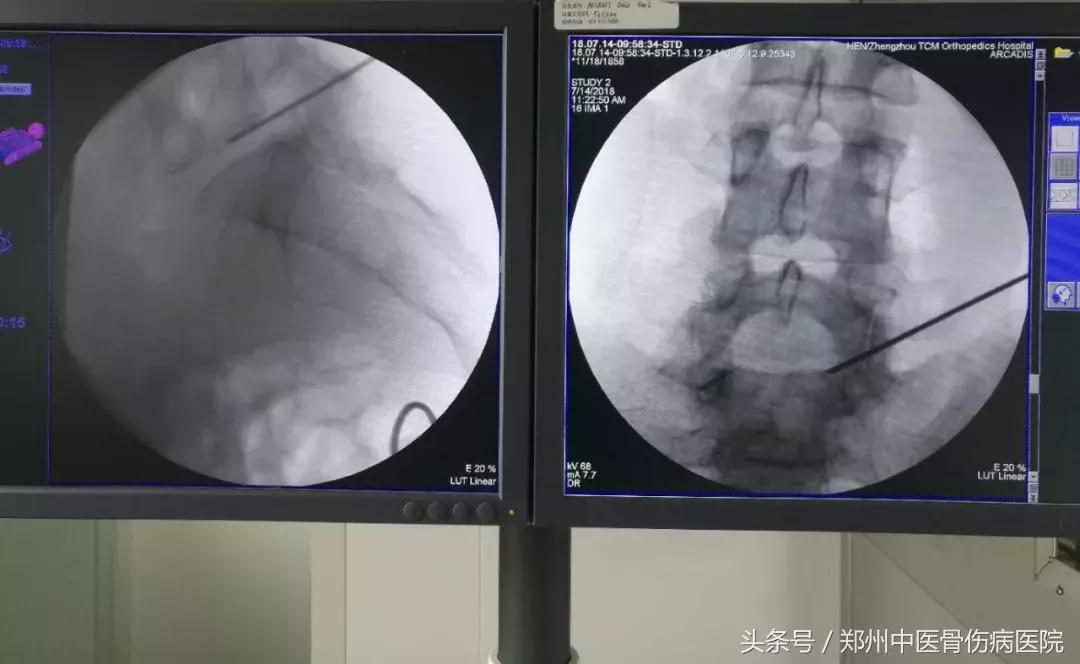 低温射频消融术治腰椎间盘突出,低温等离子消融术治疗腰间盘突出