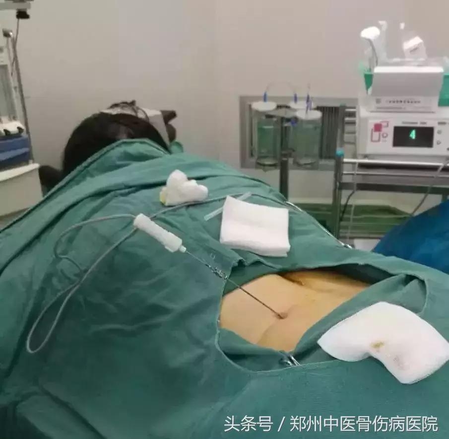 低温射频消融术治腰椎间盘突出,低温等离子消融术治疗腰间盘突出