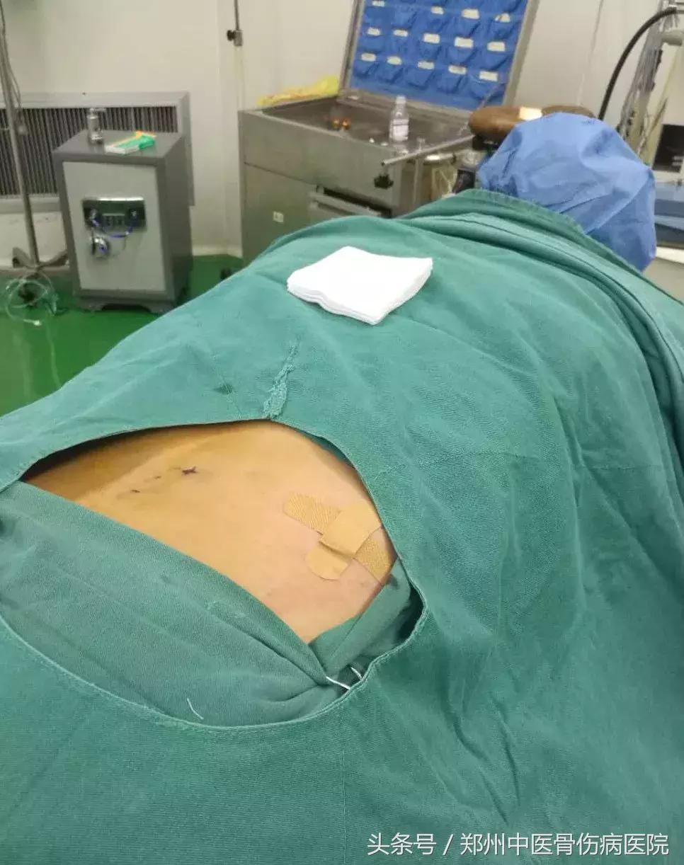 低温射频消融术治腰椎间盘突出,低温等离子消融术治疗腰间盘突出