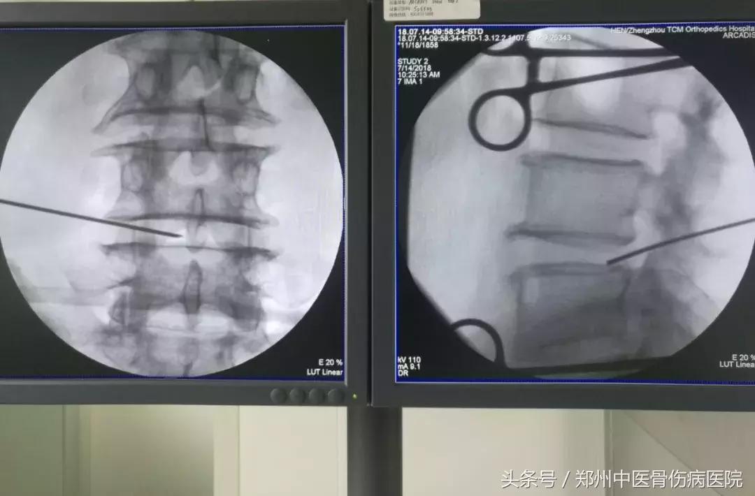 低温射频消融术治腰椎间盘突出,低温等离子消融术治疗腰间盘突出