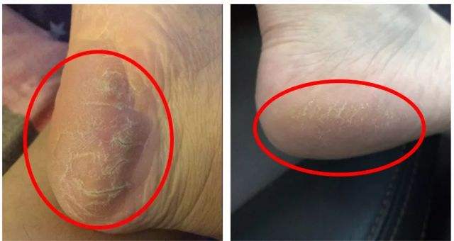 脚上死皮太硬怎么办,脚穿凉鞋都是死皮