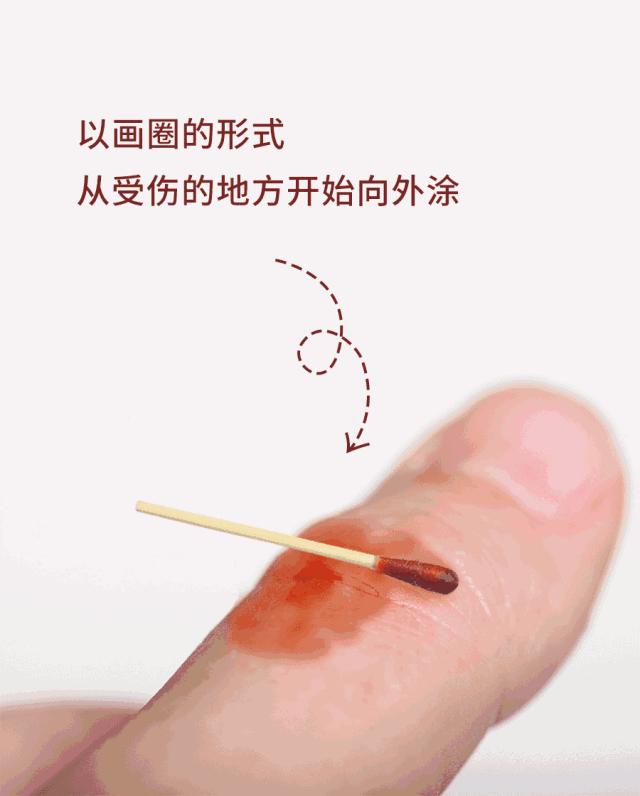 1岁宝宝烫伤护理全过程,婴幼儿烫伤处理护理操作流程