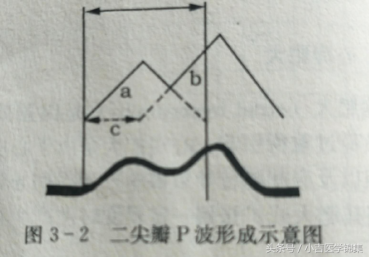 心房心室肥大,房室肥大要紧吗