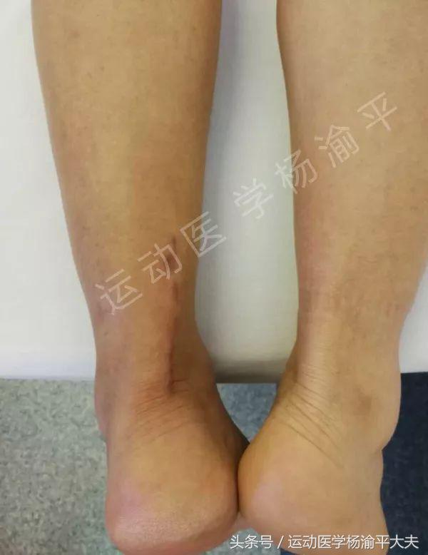 跟腱断裂保守治疗还是手术,跟腱手术干预