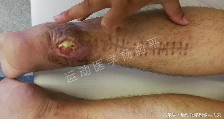 跟腱断裂保守治疗还是手术,跟腱手术干预