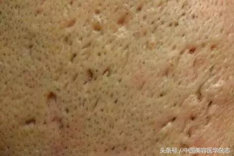 疮疤里有洞怎么修复,疮痈留下的疤能治吗