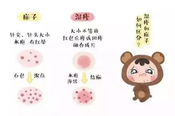宝宝湿疹和痱子可不一样，这个方法学会了，对付湿疹最好了！