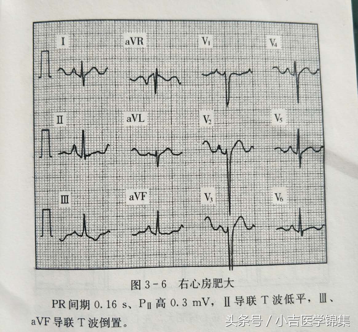 心房心室肥大,房室肥大要紧吗
