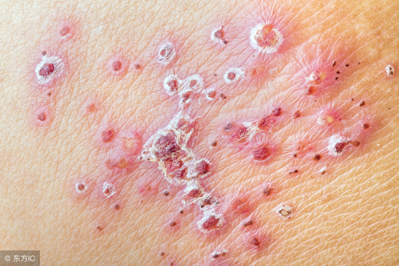 男性外阴疱疹引起的症状,男性生殖器疱疹的症状用什么药治疗