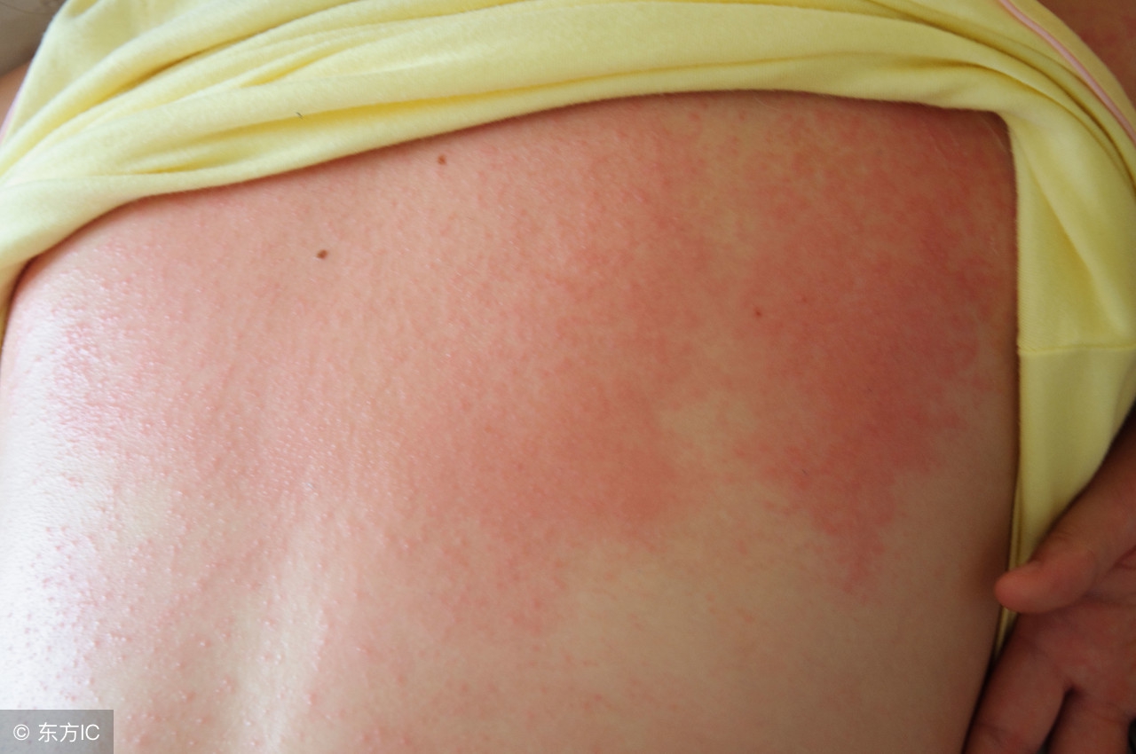 日常防晒防止晒斑,怎么预防晒斑最有效