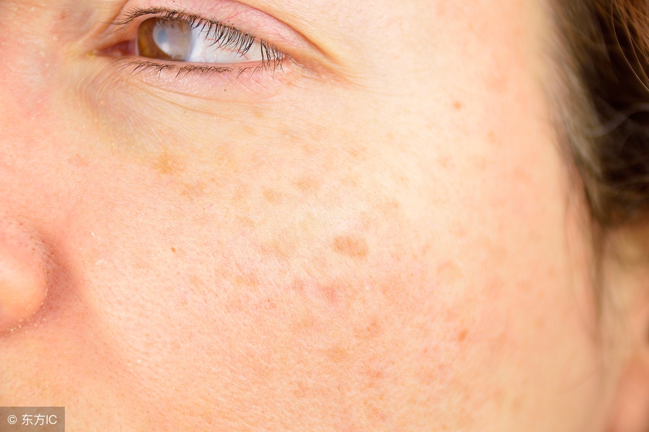 果蔬面膜美白淡化雀斑,如何用果蔬祛除雀斑细纹