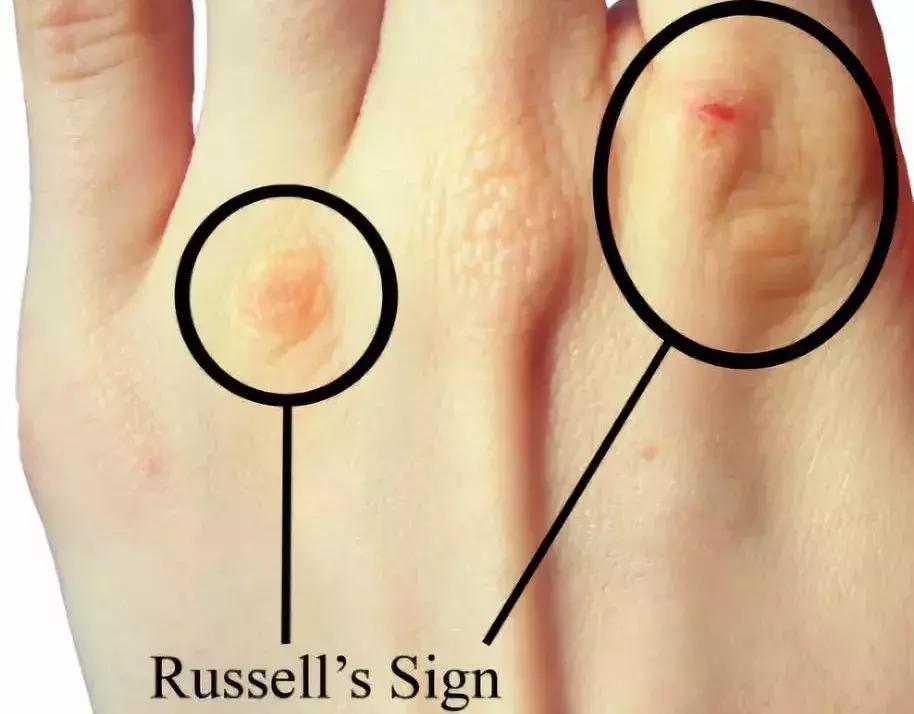 催吐，外挂般的减肥方式？吃的是欲望，吐的是灵魂