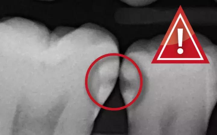 原来蛀牙是这样修复,牙齿开始蛀牙怎样防止恶化