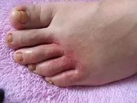 告别“香港脚”,需要用马油!一天涂抹一次,保证24小时清爽!