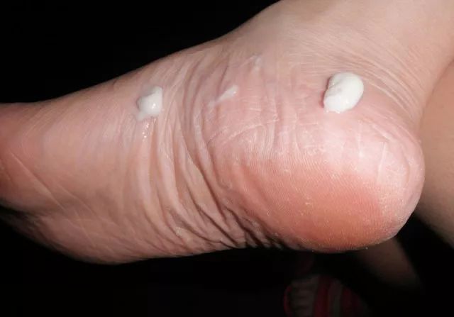 告别“香港脚”,需要用马油!一天涂抹一次,保证24小时清爽!