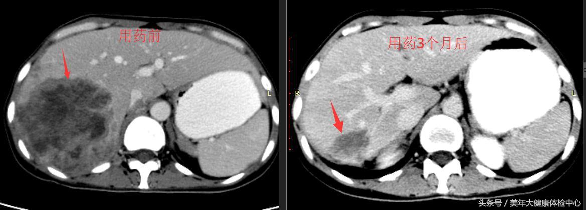 肺腺癌吉非替尼靶向药能控制几年,肺腺癌吉非替尼耐药的方式