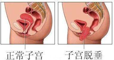 长期便秘?月子做不好?当心得子宫脱垂!