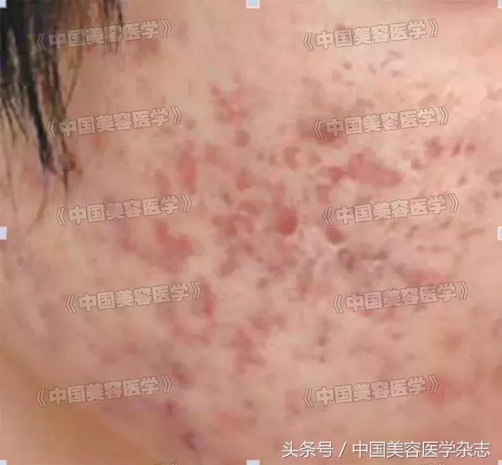 点阵激光治疗疤痕的原理,点阵激光治疗疤痕对比图