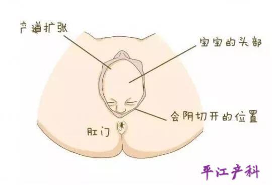 顺产后怕侧切怎么办,顺产为什么要外阴侧切