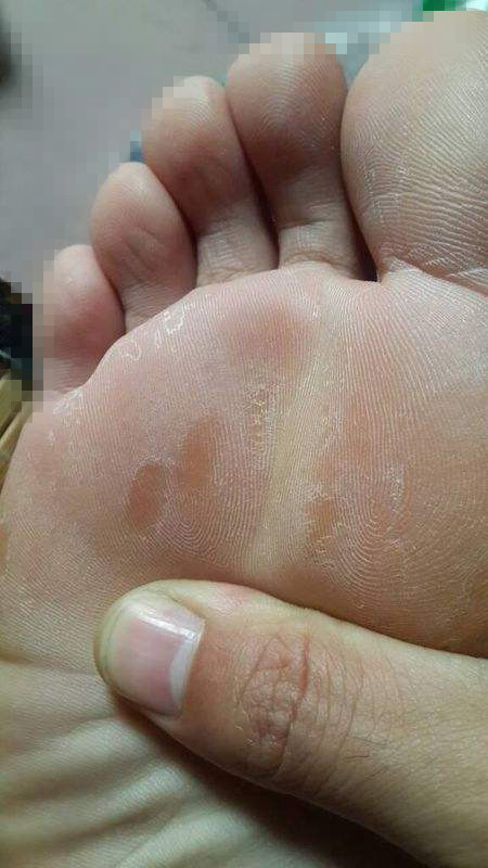 脚上长水泡脱皮还很痒怎么办,右脚脚跟长小水泡痒脱皮怎么回事