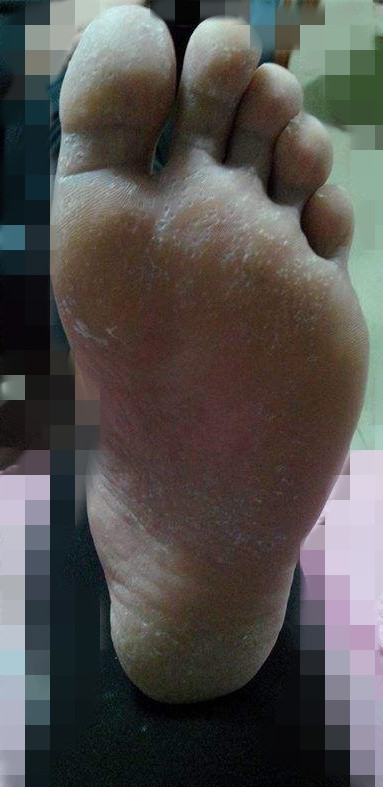 脚上长水泡脱皮还很痒怎么办,右脚脚跟长小水泡痒脱皮怎么回事