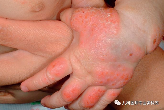 痱子和湿疹混合一起了怎么办,痱子和湿疹同时治疗用什么药