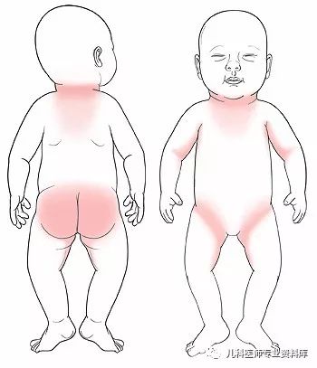 痱子和湿疹混合一起了怎么办,痱子和湿疹同时治疗用什么药