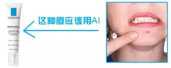 祛痘产品推荐痘肌,痘肌推荐祛痘产品