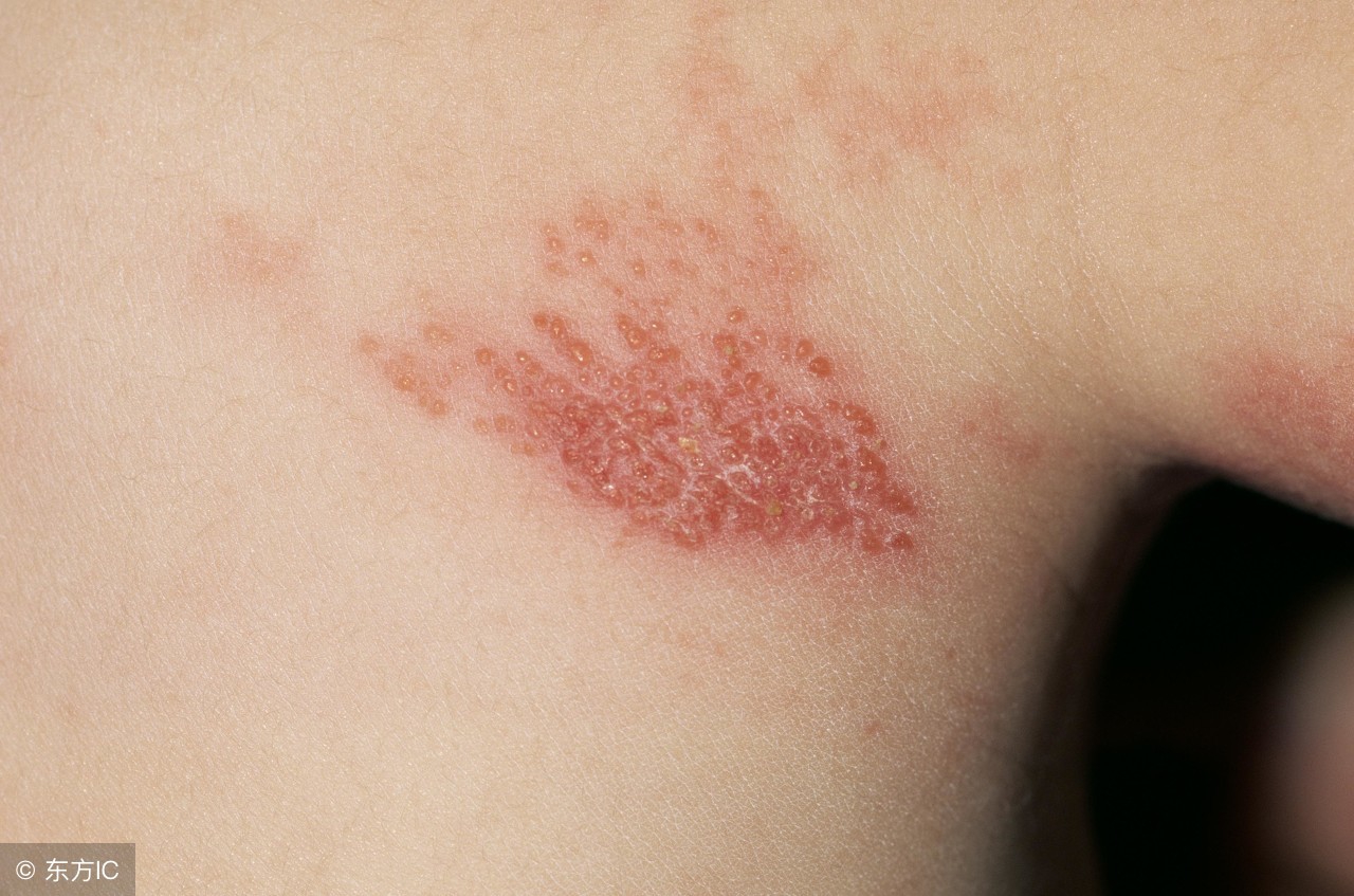 带状疱疹的后遗症症状及治疗方法,腰部带状疱疹种类及症状后遗症