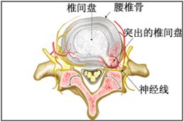 中医养生大讲堂治腰间盘突出,中医讲堂腰椎间盘突出