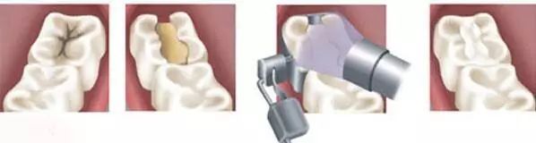 龋病的治疗科普小短文,龋病初期有无龋洞