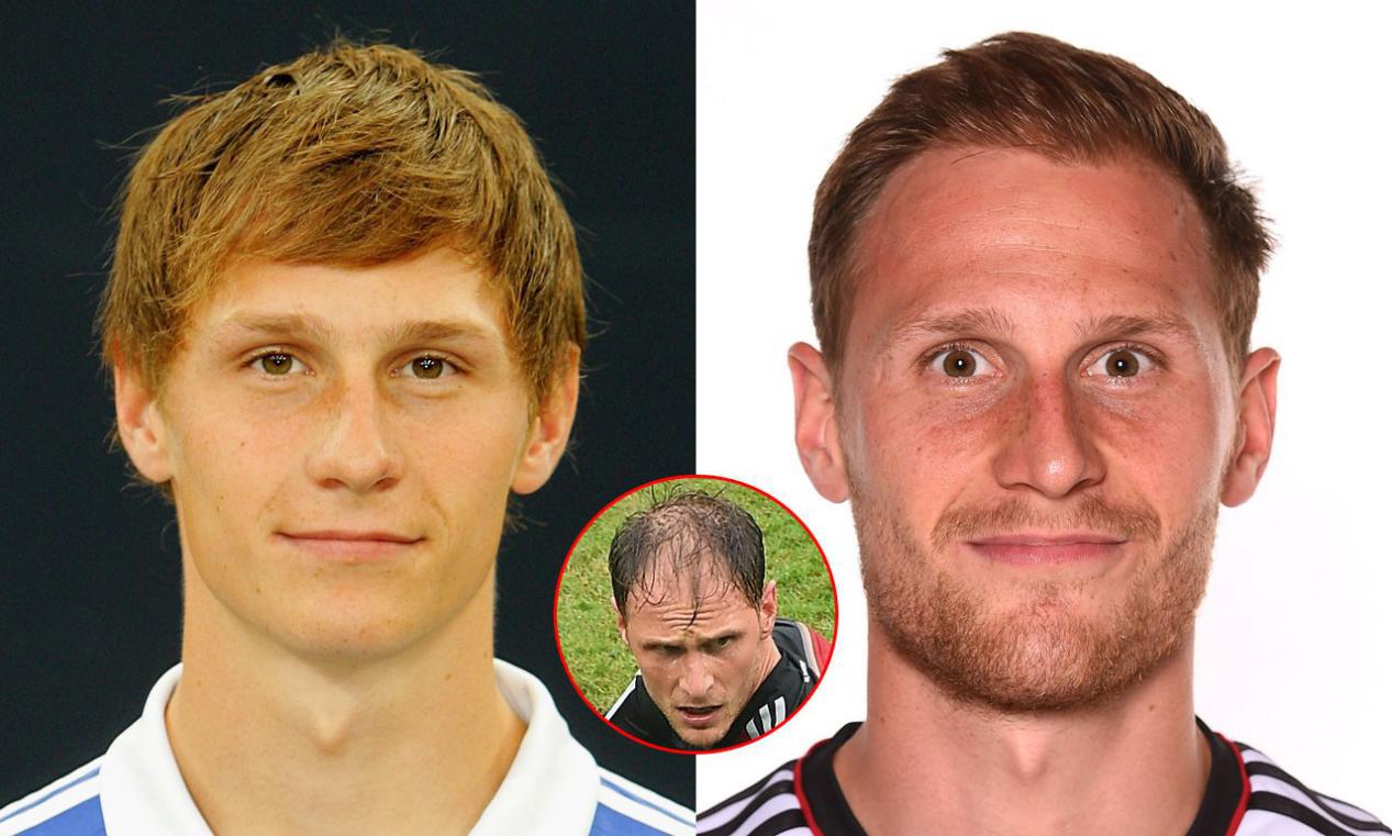 植发的危害很大，大家千万不要植发（有真相）