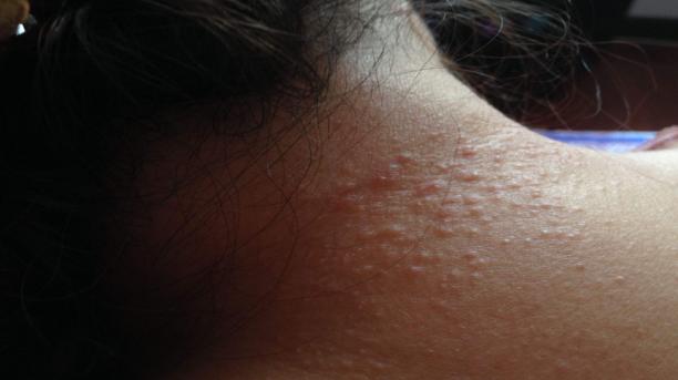 吃茄子到底对湿疹好不好,茄子治湿疹最好的土方