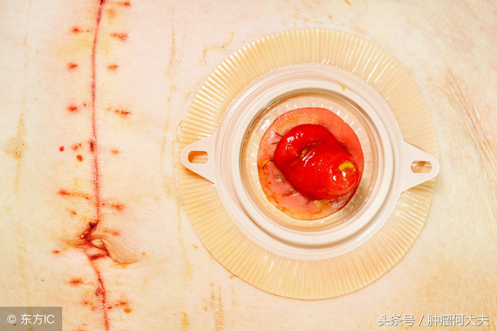 肠癌术后一年每天饮食食谱,肠癌十大禁忌食物