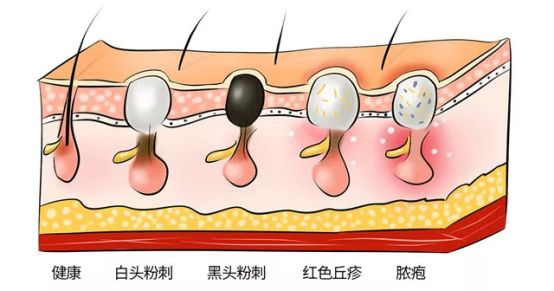 用了泥膜黑头祛不掉,黑头去不去除