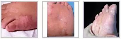 怎么拯救你，我的“大汗脚”……脚臭和脚气，有多远的距离？