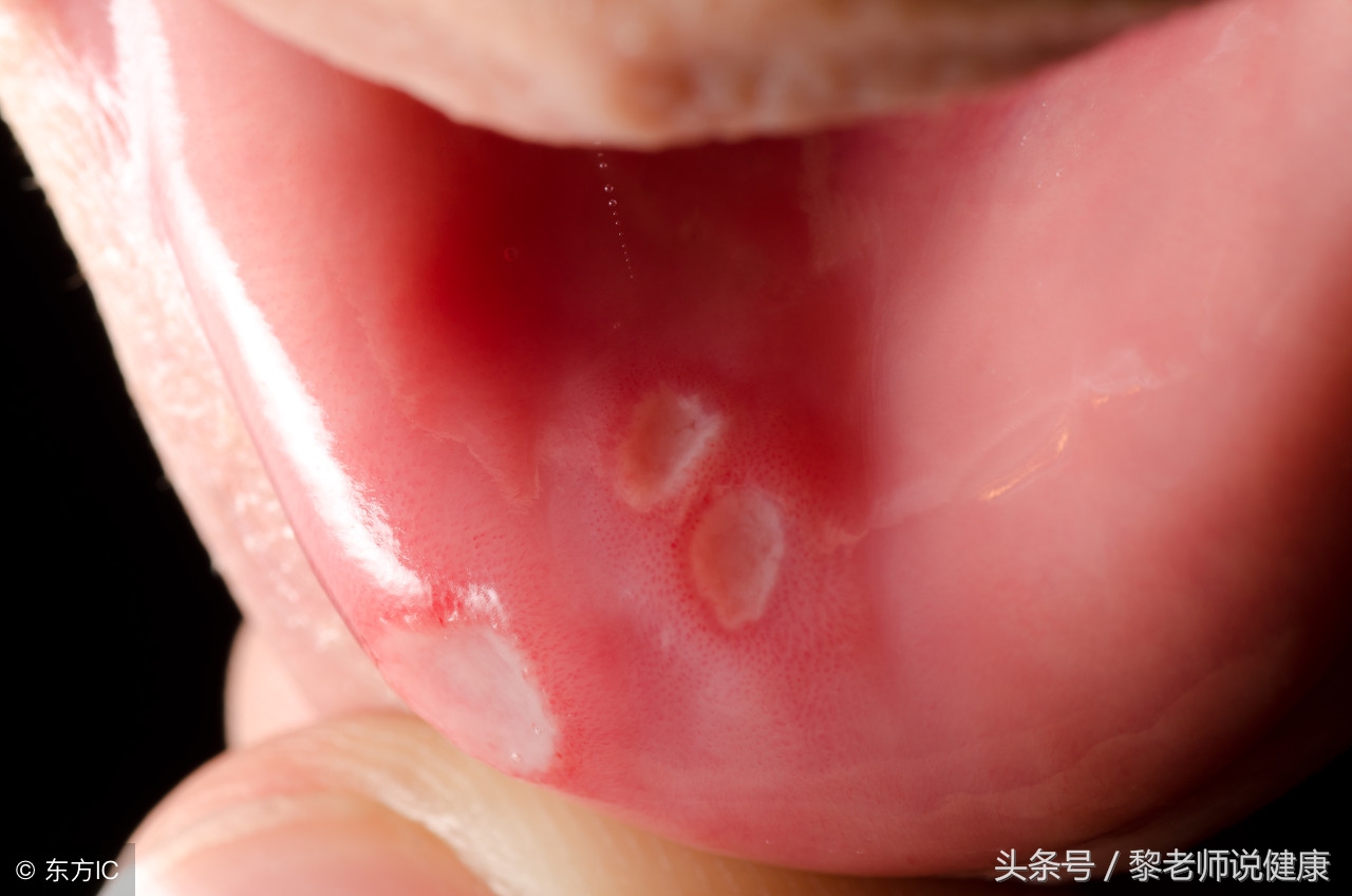 口腔溃疡是怎么治好的,长期口腔溃疡怎么办中医治疗