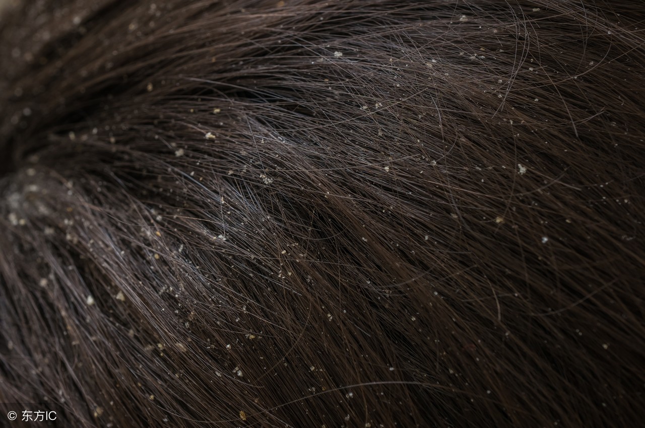 头皮屑特别多怎样防治,头皮屑增多可以试试这6个方法