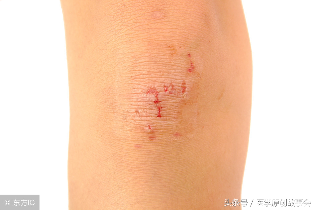 皮肤上突然出现紫色瘀斑还很疼,皮肤出现紫色瘀斑特别容易破