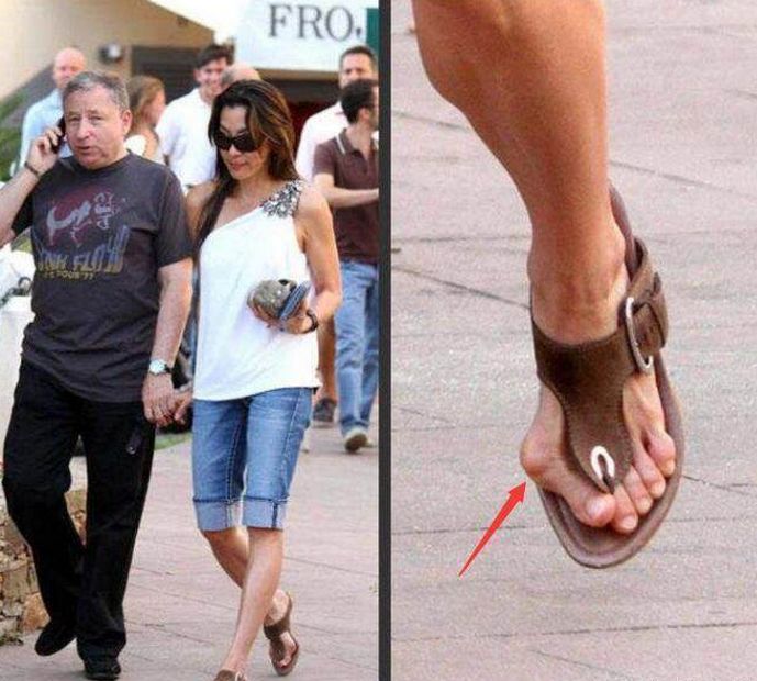 杨紫琼的脚多大,杨紫琼脚趾畸形图片