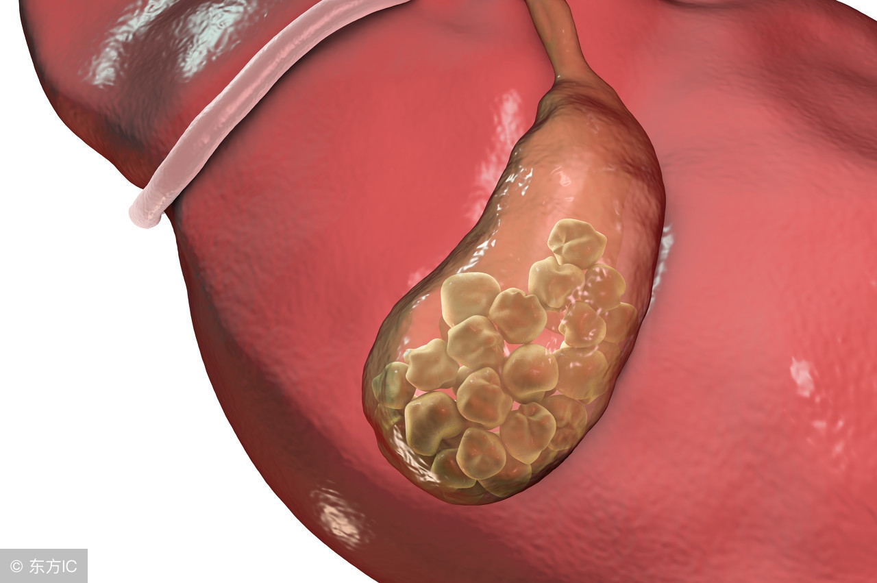 胆结石43mm算大吗怎样预防,胆囊切除术后怎么预防胆结石
