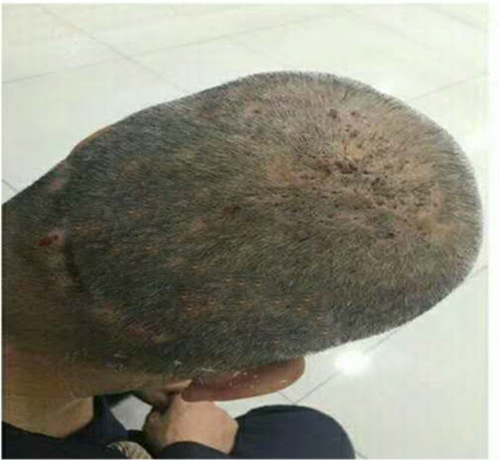 头皮顽固毛囊炎用什么洗头膏,头皮毛囊炎的症状和图片