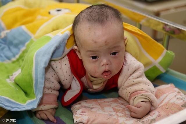 脑瘫引起的一系列并发症,脑瘫有哪些预兆