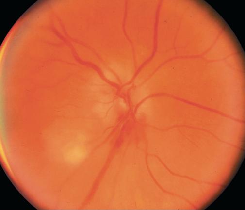 老年不明原因发热,老年人无症状发烧是怎么回事