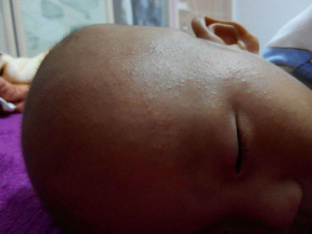 宝宝头皮有痱子需要剃头发吗,宝宝头上起痱子要不要剃头发