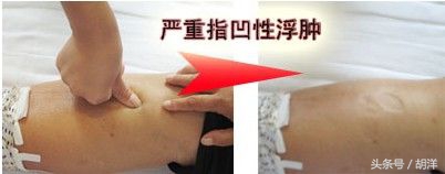 莫名脚肿了有后续吗,莫名其妙的脚肿查不出什么原因