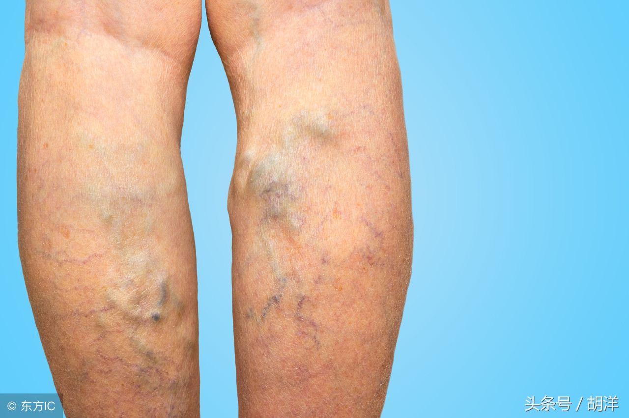 莫名脚肿了有后续吗,莫名其妙的脚肿查不出什么原因